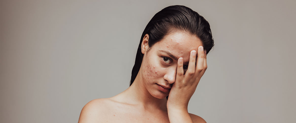 Sad girl with acne-prone skin