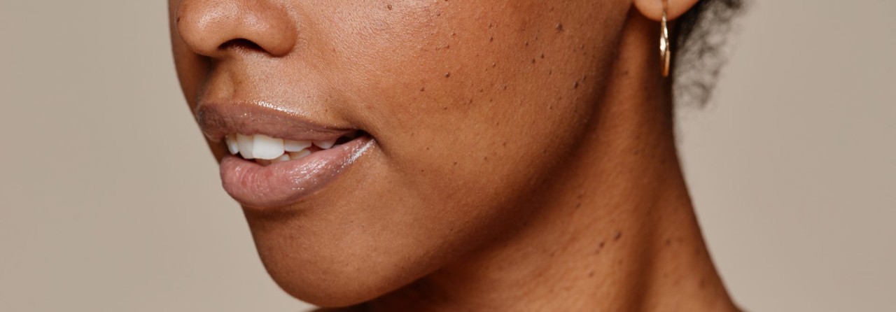 woman-with-dry-skin-acne