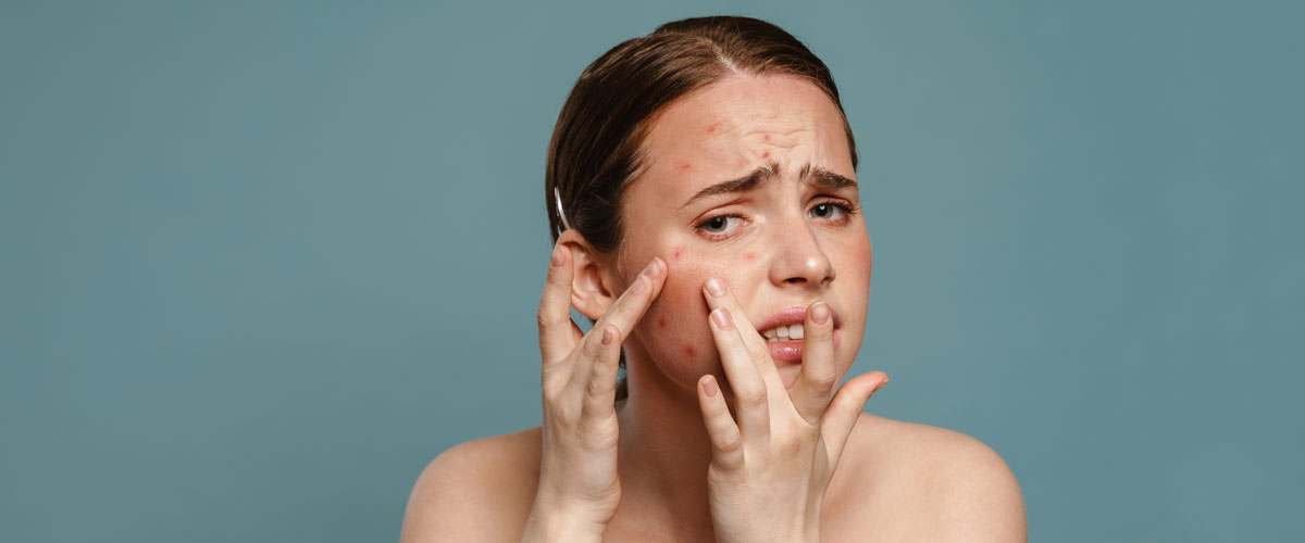 Girl with acne-prone skin